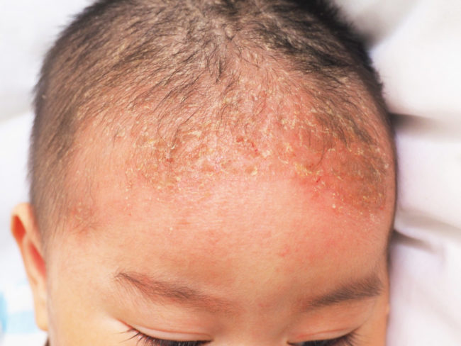 Смешанная форма дерматита у маленького ребёнка на голове