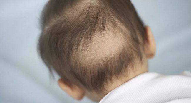 Выпадение волос на голове сзади у ребёнка