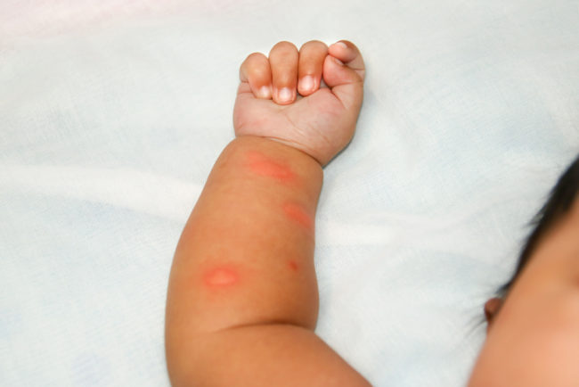 Раздражение от укуса комара у ребёнка до года на руке