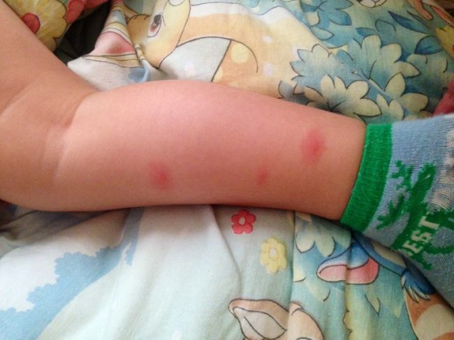 Раздражение после укуса комара на ноге у ребёнка