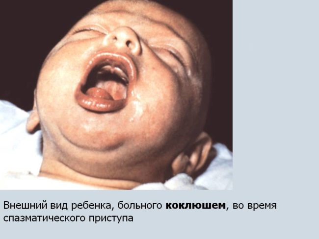 Спазм при кашле у ребёнка до года при коклюше