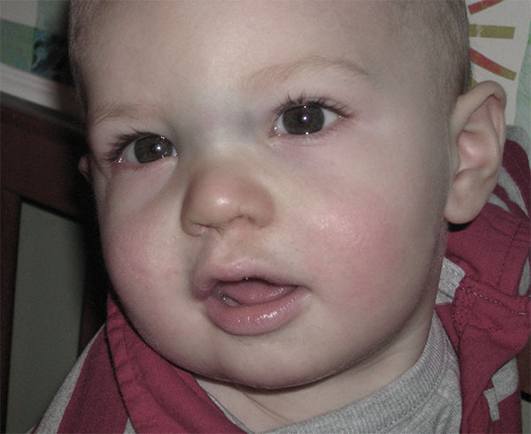 Симптомы сломанного носа у ребёнка гематома на переносице